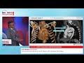 BEC 2021 | Total endovascular aortic arch repair with chimney technique | Ivo Petrov