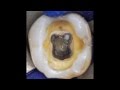 Protaper Next Case Report (2)  - Lower Right Second Molar with Pulp Stone