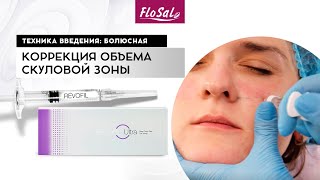 Коррекция объема скуловой зоны препаратом Revofil Ultra. Болюсная техника