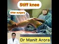 how do you fix a stiff knee through a complex surgical process when all else fails. dr manit arora