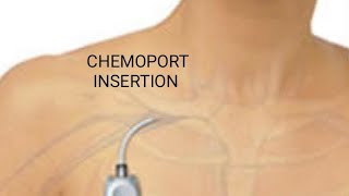 CHEMOPORT INSERTION TECHNIQUE..