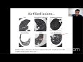 kerala iria webinar on chest radiology case presentations basics on