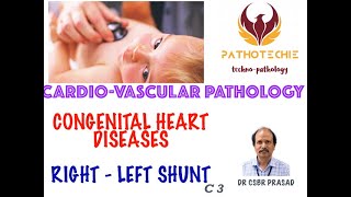 CONGENITAL HEART DISEASES - RIGHT TO LEFT SHUNT