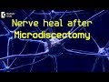 How long does it take for nerve to heal after Microdiscectomy? - Dr. Kodlady Surendra Shetty