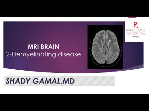 2- MRI Brain - Demyelinating Disease (MS) - YouTube