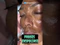 punya flek setebal ini atasi dengan darkspot anti aging