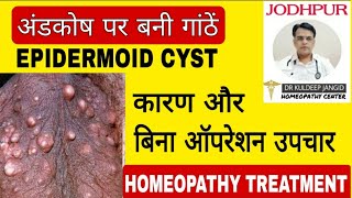 अंडकोष पर बनी गांठों का बिना ऑपरेशन इलाज । Epidermoid cyst treatment without operation ।