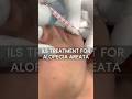 Patchy Beard Treatment of Alopecia Areata with ILS at Skinaa Clinic. #viral #shorts