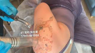 美國賽諾秀皮秒洗紋身#tattooremovalq#tattooremover #洗紋身#香港洗紋身#深圳洗紋身#皮秒洗紋身#tattooremoval#激光洗紋身#祛斑#洗纹身#澳門洗紋身#洗眉