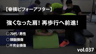 【脊損ビフォーアフター × KNL2024】頸髄損傷 - 強くなった肩！再歩行へ前進