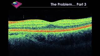 Artificial Intelligence in Ophthalmology - Reinventing the Eye Exam. Dr Pearse Keane