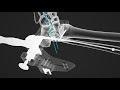 Fibula Nail 2 System Overview Animation