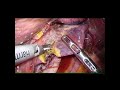 LAPAROSCOPIC LIVER RESECTION FOR THE TUMOR LOCATED IN SPIEGEL LOBE