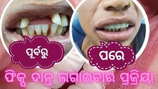 ଫିକ୍ସ ଦାନ୍ତ ଲଗାଇବାର ପ୍ରକ୍ରିୟା #fix tooth cementation procedure