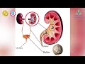 Kidney Stone? Discover Advanced Treatment with Laser technique - Noble Hospitals