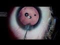 Management of Posterior Polar Cataract