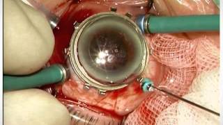 Retinal oximetry of CRVO after surgical interventions [Atsushi Hayashi]