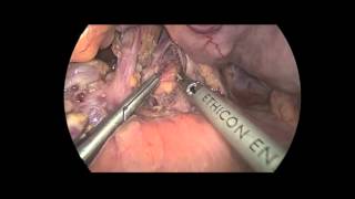 Laparoscopic Median Arcuate Ligament Release