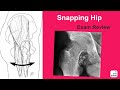 Snapping Hip Exam Review - John Clohisy, MD