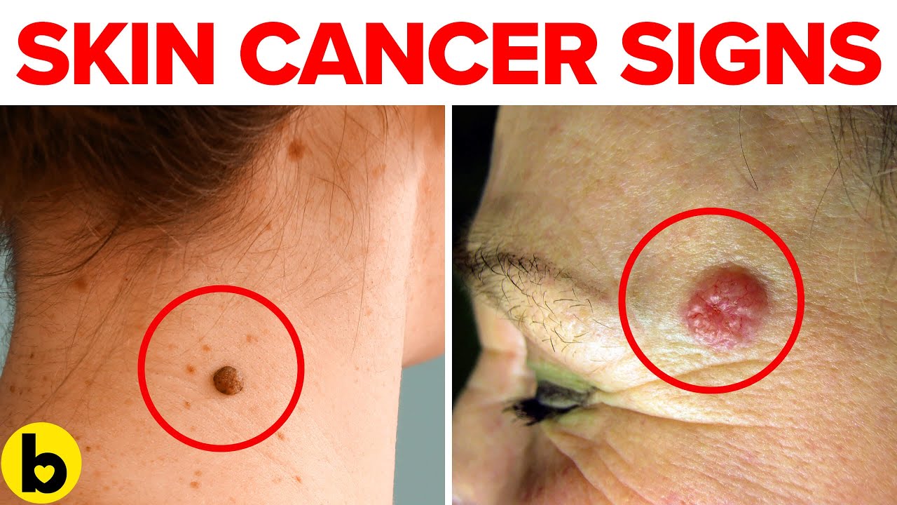 Skin Cancer Signs And Symptoms