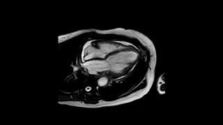 Heart Failure From Eosinophilic Granulomatosis With Polyangiitis (formerly Churg-Strauss Syndrome)