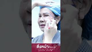 ผ่าตัดดึงหน้าคืออะไร ? #ดึงหน้า #หน้าเด็ก #หมอกันธีระธรฌ์ #facelifting #facelift  #faceliftsurgery