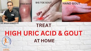 Complete Treatment Of High Uric Acid And Gout At Home |Chronic  Gout And Complications|Urdu|Hindi