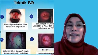 #3 Deteksi Dini Kanker dengan IVA - Cara Pemeriksaan IVA