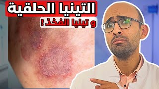 Dermatophytosis (Ringworm or Tinea Cruris) | Causes and Treatment | The answer to resistance ?!