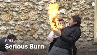 Learn first aid gestures: Serious Burn