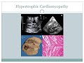 Infants of diabetic mothers (IDM)