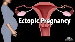Ectopic Pregnancy, Animation
