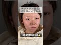 鼻整形の経過です👩🏼‍⚕️💫 鼻整形 鼻整形 アストラビューティークリニック 塩満先生 小鼻縮小 小鼻切開 鼻整形ダウンタイム 鼻尖形成 軟骨移植 鼻先 忘れ鼻 団子鼻