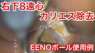 第二大臼歯遠心カリエス除去｜EENOボールチップの使用例｜右下8番遠心カリエス治療症例｜EENOチップ