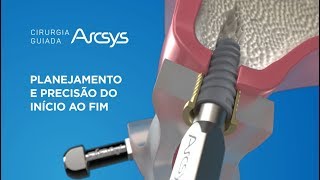 Cirurgia Guiada Arcsys - Planejamento e Precisão do Início ao Fim