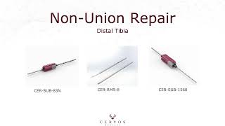 Distal Tibia Non-Union Repair with CERVOS drill-enabled instruments