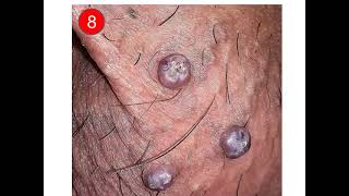 3#Interactive_Dermatology_Clinic Images 7Bullous impetigo 8Angiokeratoma of Fordyce 9Bowen s disease