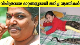 വിചിത്രമായ ജനിതക മാറ്റങ്ങളുമായി ജനിച്ച വ്യക്തികൾ | People born with shocking genetic mutation