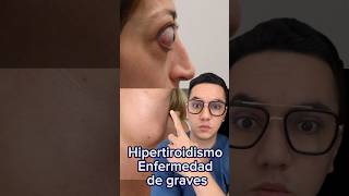 Enfermedad de graves (hipertiroidismo), síntomas de alerta. #medicina #shorts