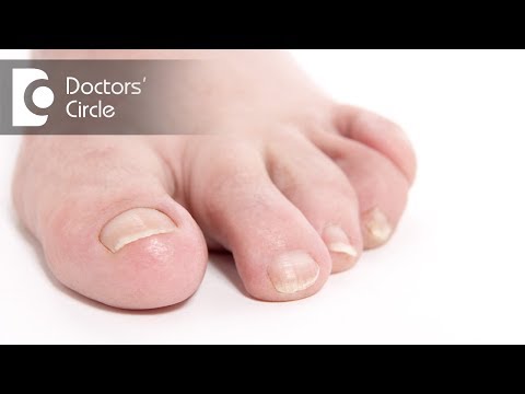 Causes of brittle toenails and its management - Dr. Rasya Dixit Causes of brittle toenails and its management - Dr. Rasya Dixit