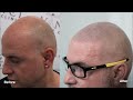 garvan´s fight against hair loss and his micro scalp pigmentation result