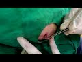 표피낭종 제거 수술 epidermal cyst excision