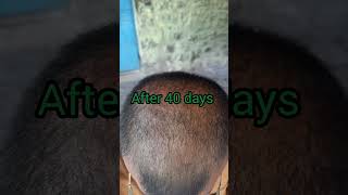 Unbelievable Result After 50 Days Using Neo Hair Lotion #shorts