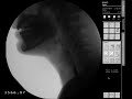 Puréed Texture/Applesauce - Modified Barium Swallow Study (MBSS) Lateral View HD