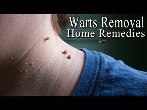 Warts - 5 Simple Home Remedies to Get Rid of Facial Warts Naturally | Warts - 5 Simple Home Remedies to Get Rid of Facial Warts Naturally |