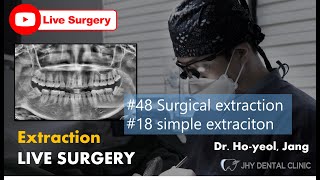 [Live surgery] minimally invasive 3rd molar extraction