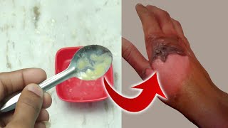 శరీరం పై కాలిన గాయాలను  తగ్గించే గృహ వైద్యం | Home Remedy for Burn | How to treat a Burn Naturally