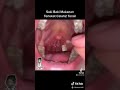 BATU KARANG CELAH TONSIL BUSUK - Story @DrManTtdi