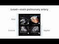 How to identify normal heart structures on a cardiac CT scan.