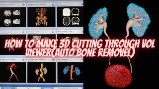 How to make 3D Cutting KUB CT Scan by Using Vol Viewer in GE CT Scan Machine #radioimaging #ctscan